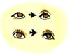 眼瞼下垂の症状8