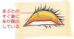瞼板法