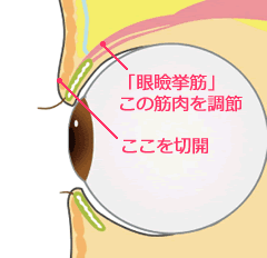 眼瞼下垂手術
